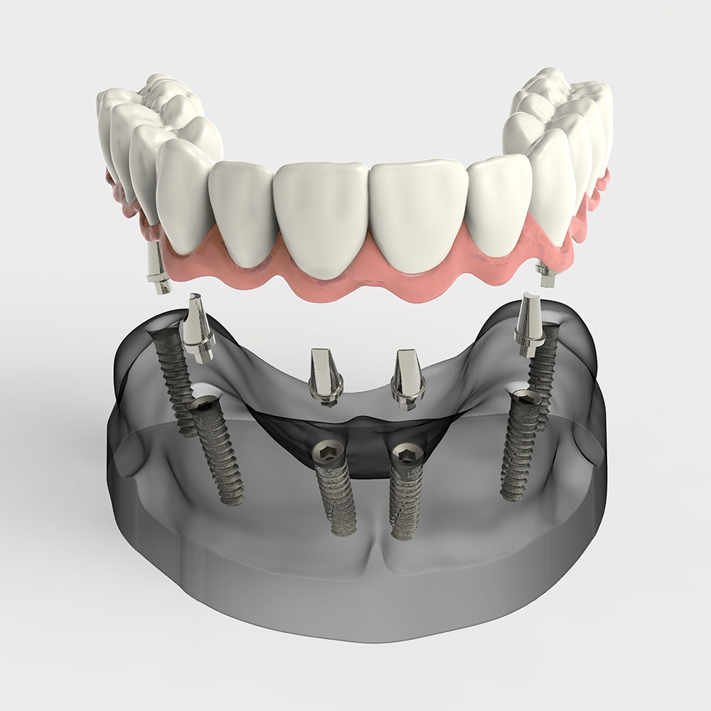 Lock Your Price - Implantology.me